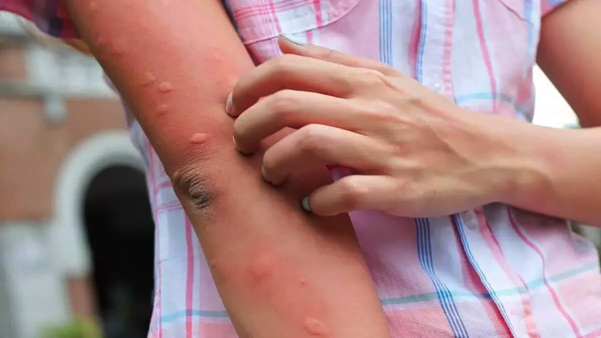 Weder eine Mücke noch eine Wespe: Das ist der gefährlichste Tierbiss des Sommers, und so erkennen Sie ihn