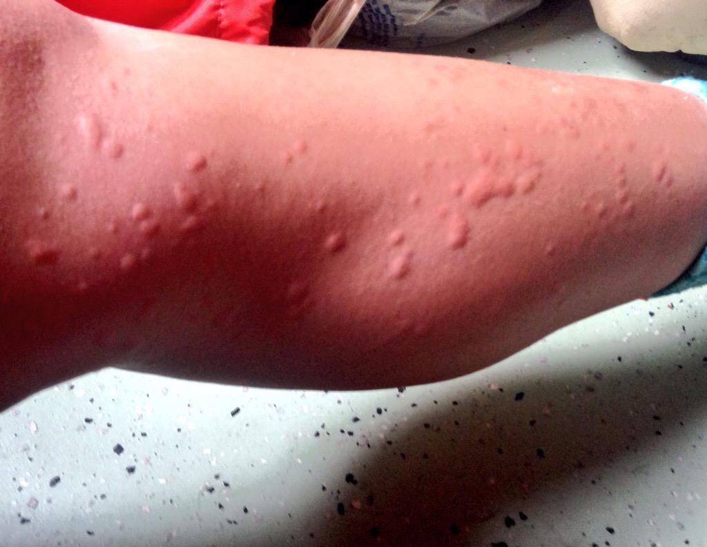 Weder eine Mücke noch eine Wespe: Das ist der gefährlichste Tierbiss des Sommers, und so erkennen Sie ihn